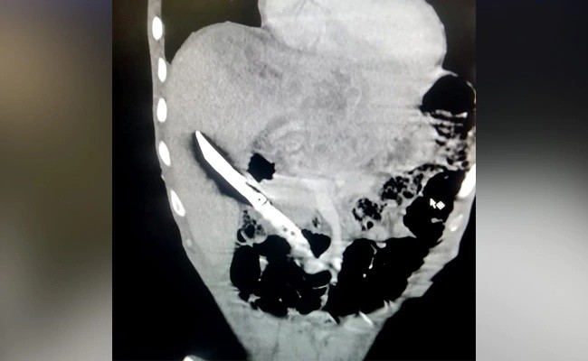医生|男子疫情期间突然想吞刀，医生从其肝脏取出20厘米长的小刀