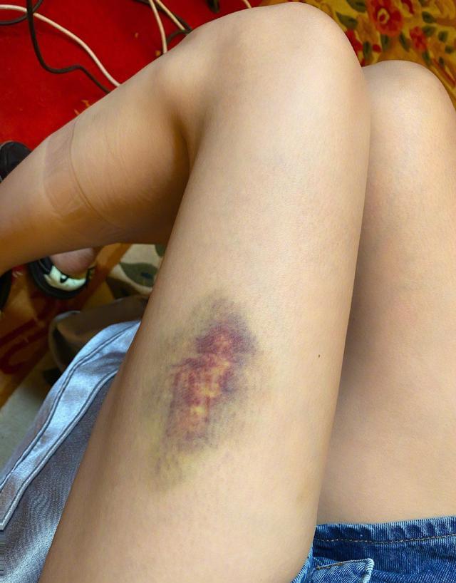 沈梦辰晒腿部淤青照小腿肚现勒痕依旧纤细评论引发猜测疑复赛