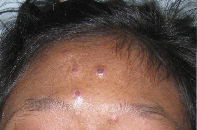 晚期艾滋病会产生哪些机会性感染症状?看完后明白了!