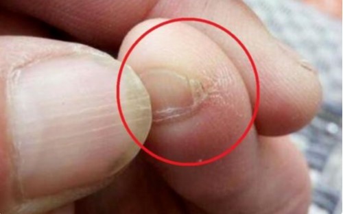 为什么很多中国人的小拇脚趾都是两半是什么疾病吗其实是这样