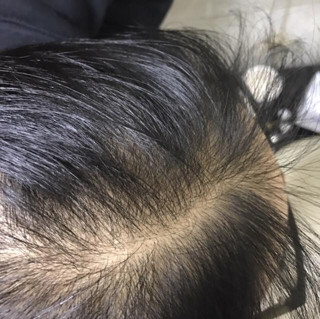 头发少怎么能生发六个方法让你头发变浓密