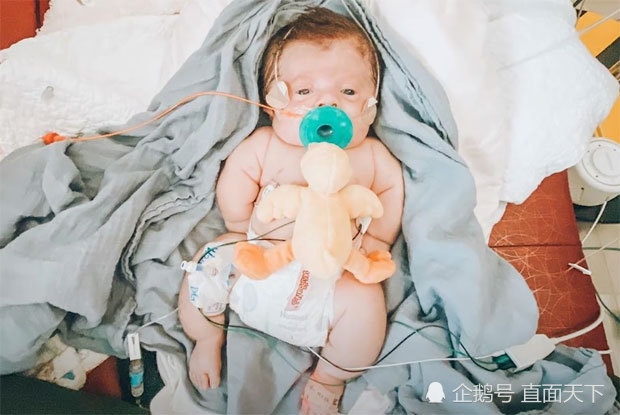 孩子|一抱就碎的婴儿：“玻璃王子”艰难挺过4个月