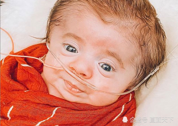 孩子|一抱就碎的婴儿：“玻璃王子”艰难挺过4个月