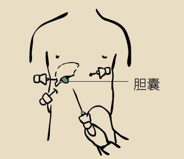 胆囊穴位 腾讯网
