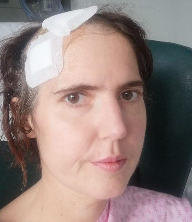 丽贝卡·道尔顿|英国女智齿发炎，因怀孕无法及时手术，谁料被细菌侵入大脑险丧命