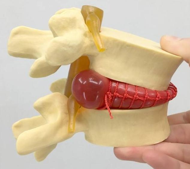 腰椎間盤突出,有沒一勞永逸的