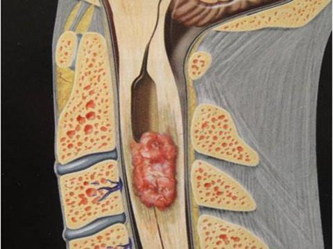 脊髓肿瘤能治好吗