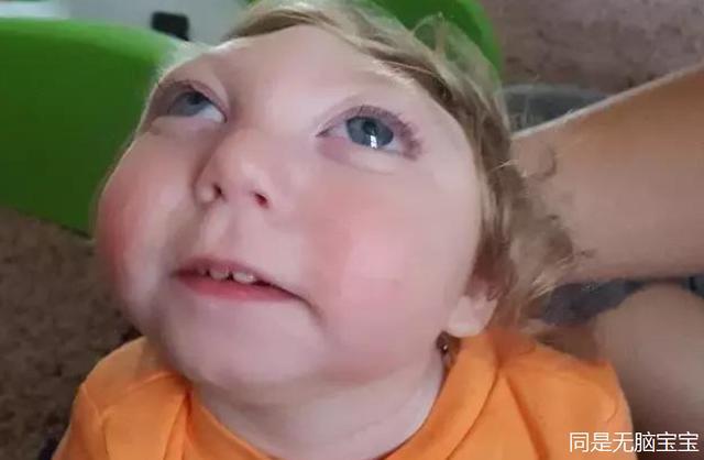 父母坚决生下无脑宝宝三年后脑子长出大半医生医学奇迹