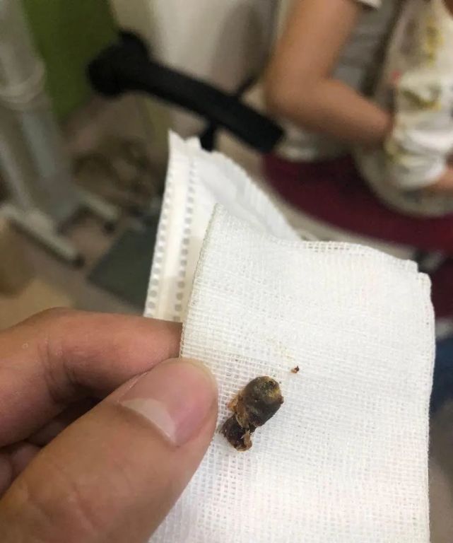 出现这个问题,得赶紧就医|耳道|宝宝|耳屎