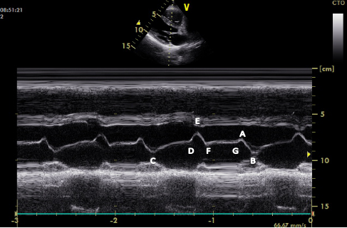 (以上内容源自《超声心动图规范检测心脏功能与正常值》)g点:代表左心