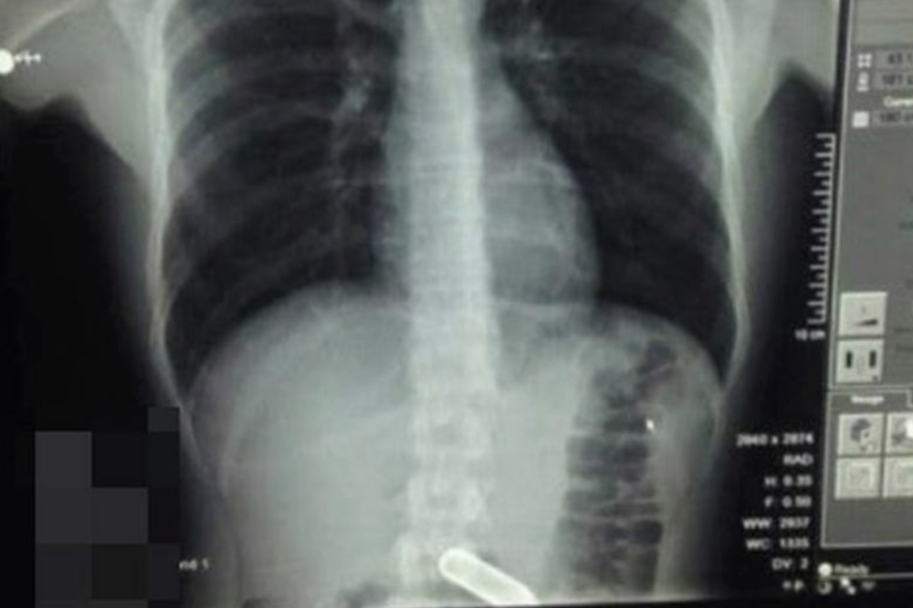 爆炸|英国男孩和同学打赌吞下一个笑气罐，医生担心气罐会在他胃里爆炸