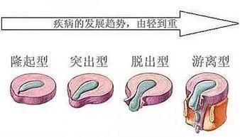 腰椎間盤突出與膨出有什麼區別如何治療武漢協和吳星火