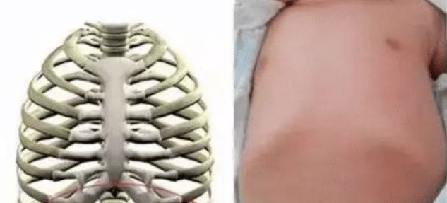 宝宝肋骨外翻是佝偻病?解析婴儿肋骨外翻的原因,家长要及时了解