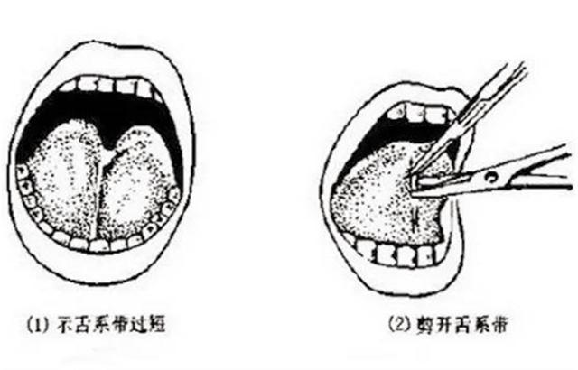 让众多孩子无辜受了罪,唯两种情况要注意|孩子|舌系带|舌头|舌系带过