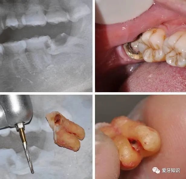智齿的术前阻力评估才能实现微创拔牙