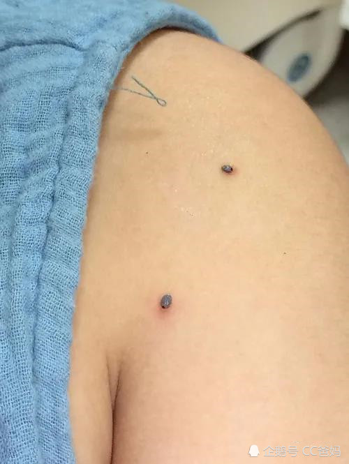 蜱虫在夏季活动尤为频繁,常出现在草丛,灌木丛等植物茂密的地方.