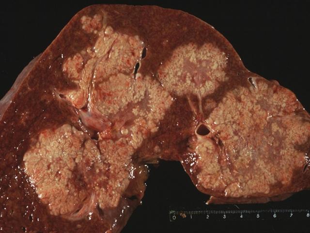 肝病医生提醒:肝癌最喜欢你做的三件事,不要再傻傻的做了