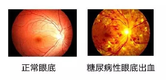 眼科专家桂君民:眼底病变不是小事 糖尿病并发症竟如此严重!