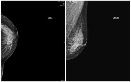 乳腺浸润性导管癌 级严重吗乳腺浸润性导管癌的 级是否严重 有来医生