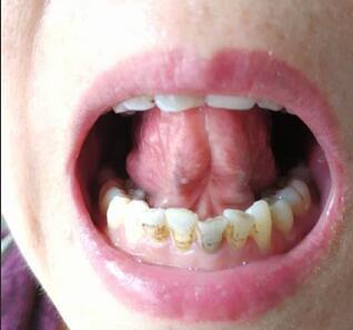 猛然发现舌头下面有很多突出的黑筋什么病需要如何治疗