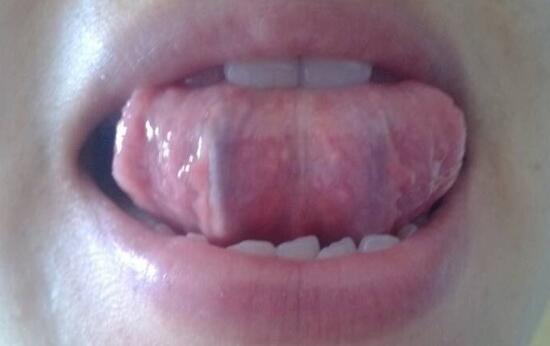 舌下青筋发黑,什么情况?是有什么病吗?