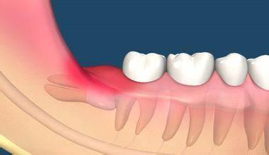 为什么大多数情况下智齿都需要拔除？