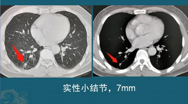 咳嗽發現肺結節3天沒睡好手術切開是良性賺了還是賠了