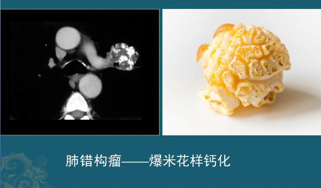 典型的像一颗爆米花一样,有确诊价值,如
