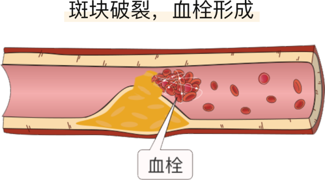 这种堵住动脉血管的血块就是动脉血栓.