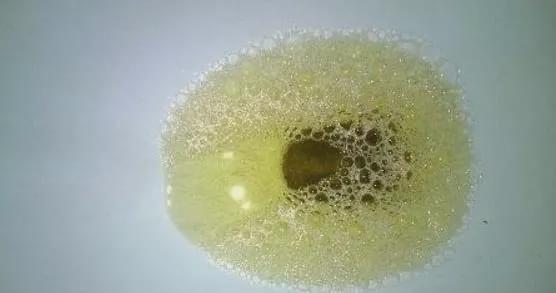 肾脏|肾脏异常，身体会有四个表现，若占上一个，三件事要尽早戒掉！