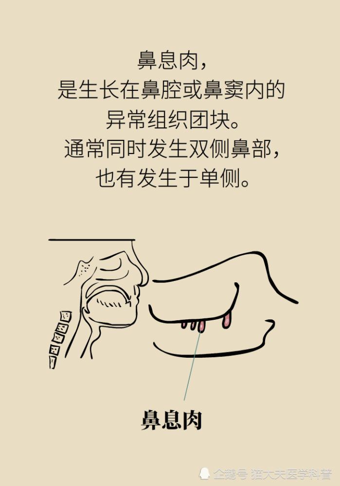鼻息肉|鼻息肉，只是鼻子里长了块肉？