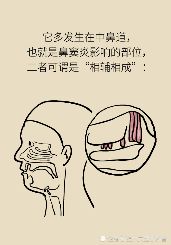 鼻息肉|鼻息肉，只是鼻子里长了块肉？