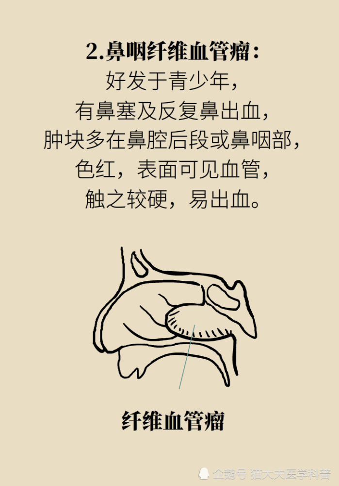 鼻息肉|鼻息肉，只是鼻子里长了块肉？