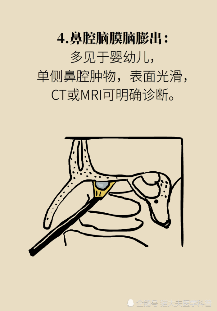 鼻息肉|鼻息肉，只是鼻子里长了块肉？