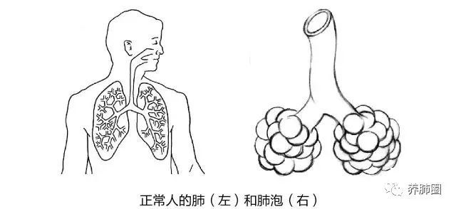 肺疾病(簡稱:慢阻肺)是由於長期吸入有害氣體導致的慢性呼吸系統疾病