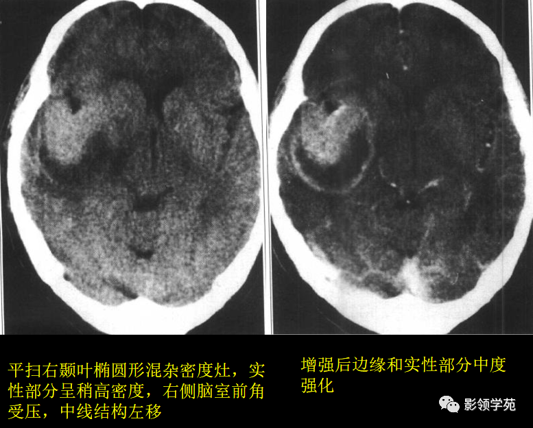 前者病程較長,因此可引起蝶鞍擴大,鞍背變薄等徵象;後者由於發病急,故