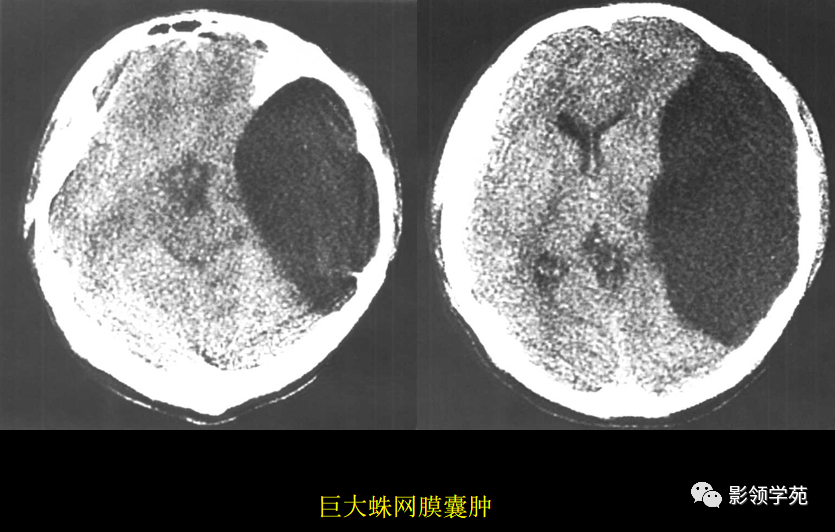 ct表现(1)平扫蛛网膜囊肿表现为局部脑裂或脑池扩大,膨胀性生长