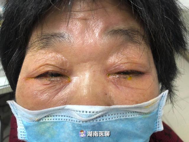 乱滴眼药水?小心护眼变害眼,听听专家的建议