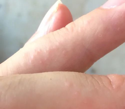 水泡疹 腾讯网