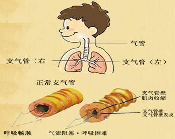 小兒支氣管炎是常見的疾病,大多是因為長期咳嗽引起,當寶寶長期咳嗽