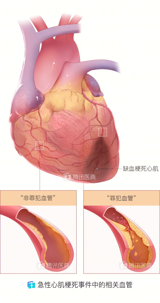 心肌梗塞|心梗了，该不该开通“非罪犯血管”？医生：要考虑这些因素！