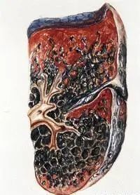 尘肺病|肺里灌满白水泥？7旬大爷呼吸困难，竟是因为年轻时……