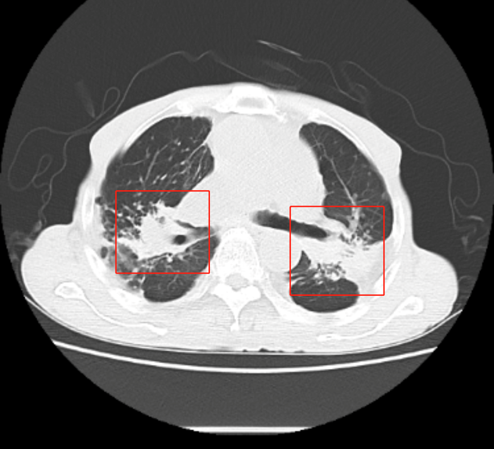 尘肺病|肺里灌满白水泥？7旬大爷呼吸困难，竟是因为年轻时……