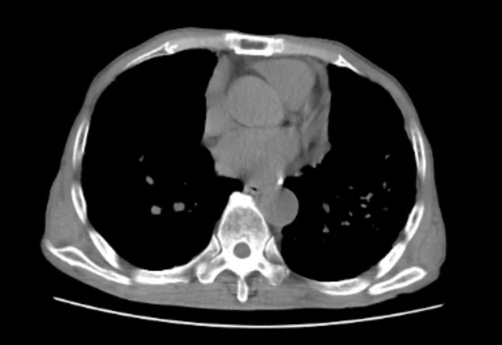 尘肺病|肺里灌满白水泥？7旬大爷呼吸困难，竟是因为年轻时……