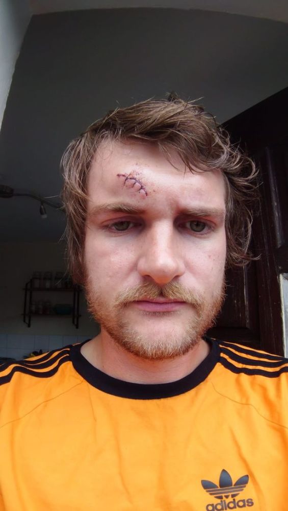 英国_社会|英国夫妇因一句随口夸奖被一群孩子追打，头部连缝数针大呼可怕