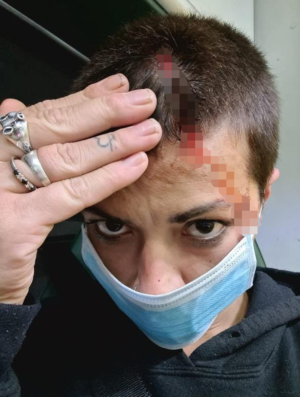 英国_社会|英国夫妇因一句随口夸奖被一群孩子追打，头部连缝数针大呼可怕