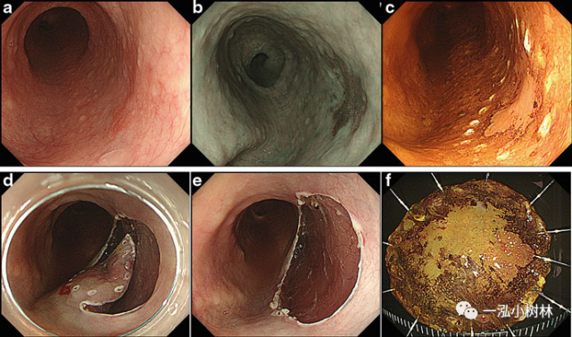 早期食管癌的治疗策略