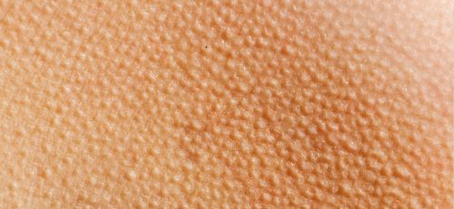 "鸡皮肤"我们医学名称为毛周角化病,又叫毛发角化病,毛发苔藓,这不是