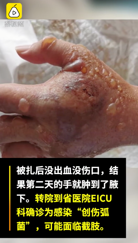 只因被鱼刺扎伤手,男子住进icu面临截肢