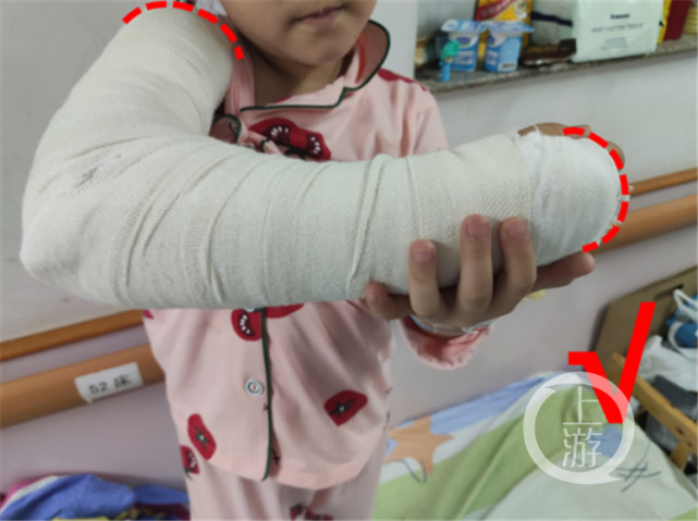 为右侧肱骨髁上骨折,移位明显,医生为他进行复位后,用石膏进行了固定